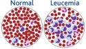 ARTÍCULO :: Eliminación de Células Troncales Leucémicas: el modelo de la Leucemia Mieloide Crónica