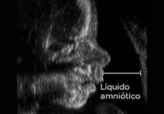 Lanza en México prueba ambulatoria de detección de pérdida de líquido amniótico no invasivo y ambulatorio