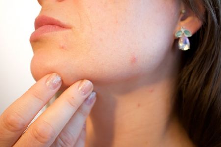 Cambios hormonales durante la mediana edad, especialmente en las mujeres, pueden derivar en acné