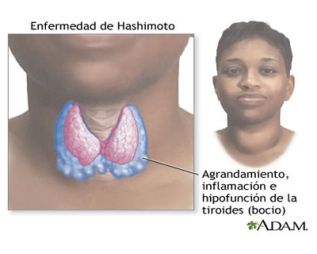 Tiroiditis de Hashimoto