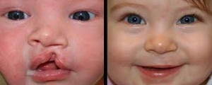 Más de 3,500 bebés nacen cada año con labio y paladar hendido en México: una condición tratable, pero inaccesible para miles de familias