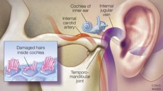 Los implantes cocleares, alternativa ante pérdida auditiva avanzada