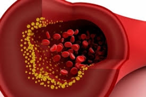 Urge reducir el colesterol LDL para evitar el riesgo de enfermedades cardiovasculares