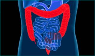 Cáncer colorrectal