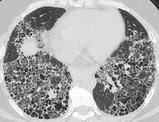 Fibrosis Pulmonar Idiopática, enfermedad que arrebata la respiración
