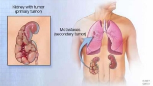 En los últimos años, los hombres tienen mayor probabilidad de desarrollar cáncer renal