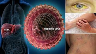 Siete datos sobre la hepatitis C