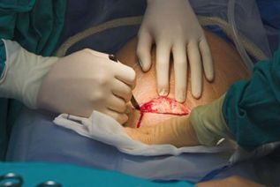 Cesáreas, bajos índices de lactancia y abuso de antibióticos pueden afectar la salud intestinal de infantes