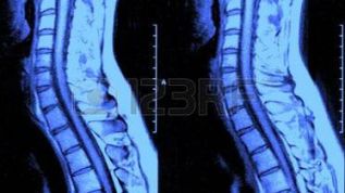 Cómo detectar y tratar una hernia discal