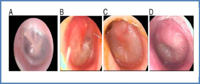 El 80% de los niños sufre al menos un episodio de otitis media antes de los 6 años