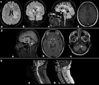 Estudio muestra que fármaco reduce el riesgo de recaída de neuromielitis óptica