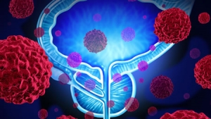 Método novedoso mejora la detección y el tratamiento del cáncer de próstata