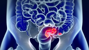 Estudio del CINVESTAV revela claves para entender el cáncer colorrectal