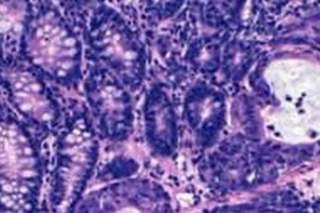 Mayo Clinic desarrolla una nanopartícula que encoge tumores de cáncer de mama y evita su recurrencia, ¿vacuna?