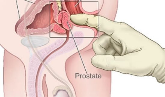 Investigadores del Cinvestav emplean extracto de jitomate para revertir hiperplasia prostática