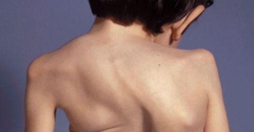 Síndrome de Morquio: enfermedad huérfana difícil de diagnosticar