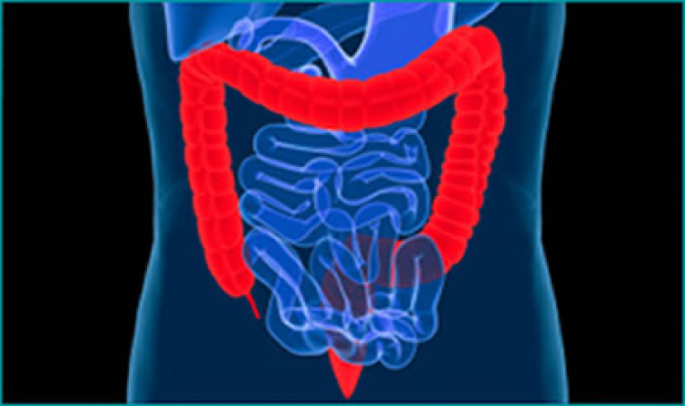 El cáncer colorrectal ocupa la sexta causa de muerte en México por neoplasias