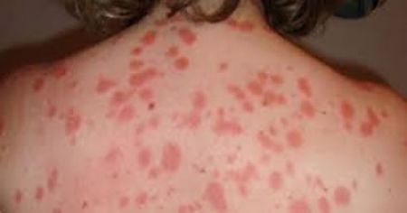 En México la psoriasis representa el 2% de las enfermedades de la piel