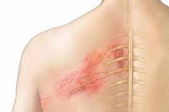 ¿Qué es el virus del herpes zóster?