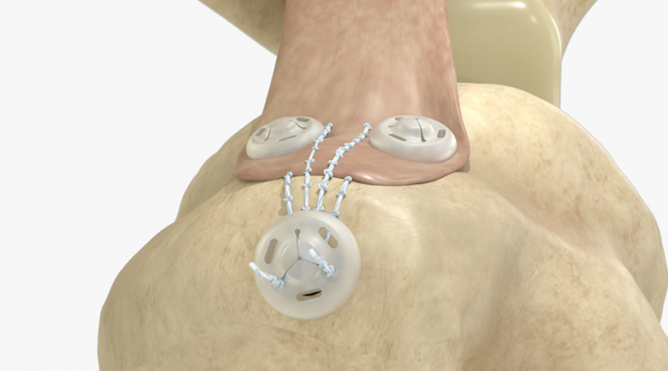 Profesor del Tec de Monterrey crea cinchos quirúrgicos para reparar tendones y ligamentos