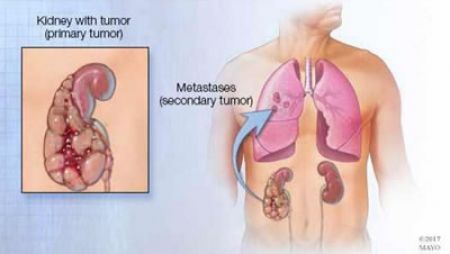 Investigación de Mayo Clinic muestra que cirugía prolonga la vida de pacientes con cáncer renal