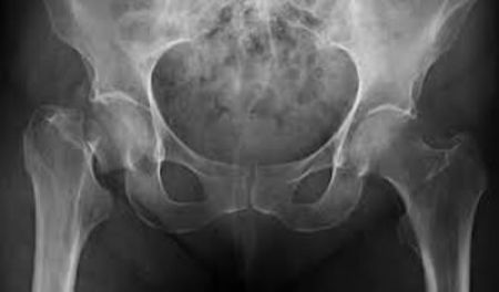 Osteoporosis, puede presentarse a partir de los 20 años de edad