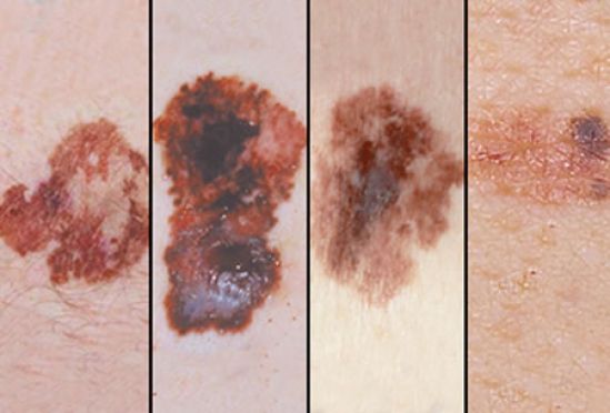 Incidencia de melanoma en México y el mundo