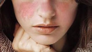 La inactividad, el aislamiento y el impacto sobre la vida diaria son las principales preocupaciones de quienes padecen de lupus