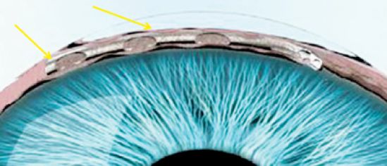 Alcon presenta revolucionario dispositivo tecnológico para el tratamiento de glaucoma