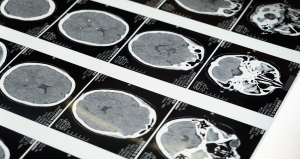Falta de información e ignorancia retrasa su detección oportuna del Alzheimer