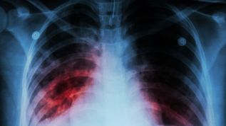 Fibrosis Pulmonar Idiopática, una rara enfermedad que puede robarte el aliento