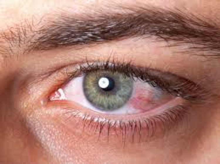 Uno de los síntomas del COVID-19 puede ser la conjuntivitis