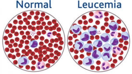 La leucemia linfoblástica aguda es el tipo más frecuente de leucemia en un 75-80%