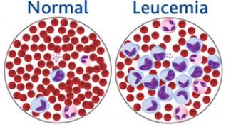 La leucemia linfoblástica aguda es el tipo más frecuente de leucemia en un 75-80%