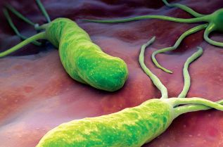 La bacteria Heliobacter Pylori puede provocar cáncer gástrico