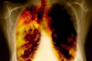 Cáncer de pulmón recibe menos atención en México a pesar de ser el más mortal