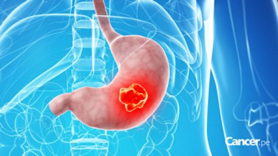 Impulsan creación de Programa Integral para prevenir cáncer gástrico en México