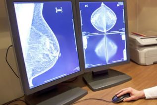 Mayor supervivencia global en cáncer de mama avanzado, según estudio MONALEESA-7