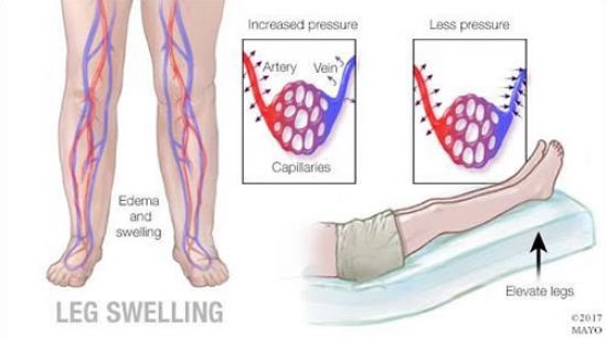 La hinchazón leve de las piernas debe evaluarse