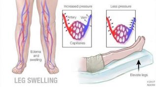 La hinchazón leve de las piernas debe evaluarse