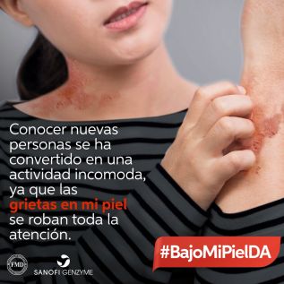72% de quienes padecen dermatitits atópica ve afectada su calidad de vida con la enfermedad
