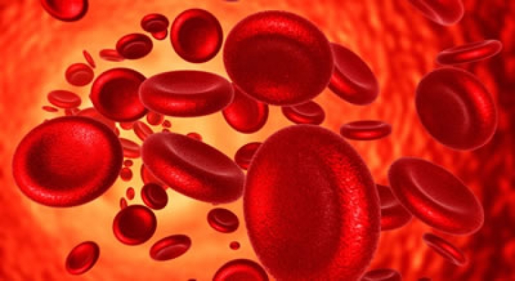 Anemia podría revelar Síndrome Mielodisplásico en adultos