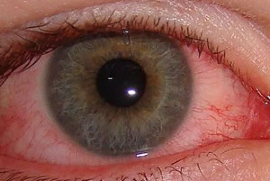 México libre de tracoma, enfermedad infecciosa que provoca ceguera