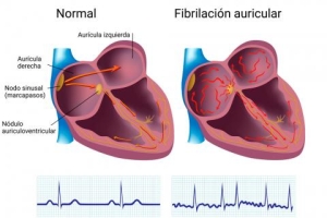 Lanzan tecnología innovadora para tratar la fibrilación auricular, arritmia más frecuente y que afecta a 2.5 millones de personas en México