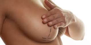 Solo 10% de las mujeres con mastectomía reconstruyen su pecho