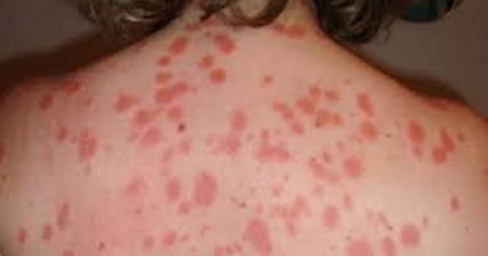 Inmunoterapia dirigida disminuye los síntomas visibles y mejora la calidad de vida de niños y adultos con psoriasis