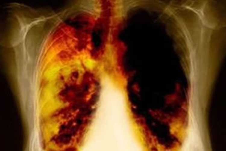 Cáncer de pulmón en México letal, por su detección tardía