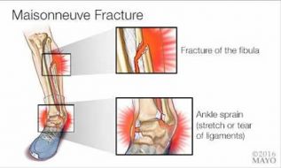 Fractura de Maisonneuve 