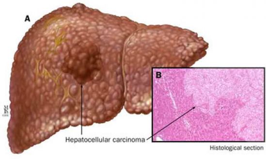 Hepatocarcinoma o cáncer de hígado con 6,300 casos nuevos al año en México