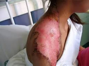 Estudian en la UNAM materiales para curar quemaduras graves